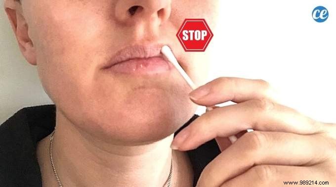 Grandma s Time-Tested Remedy: Quickly Dry Up Cold Sores on Lips with 70% Alcohol