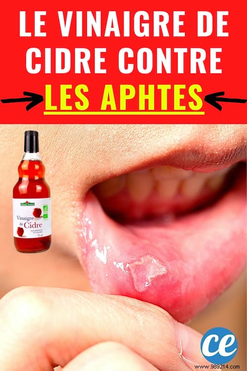 2 Proven Apple Cider Vinegar Remedies for Canker Sores and Gingivitis