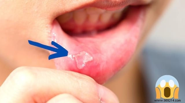 2 Proven Apple Cider Vinegar Remedies for Canker Sores and Gingivitis