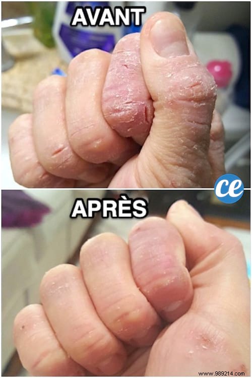 Heal Cracked Hands Naturally: Time-Tested Grandmother s Essential Oil Remedy