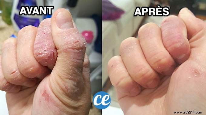 Heal Cracked Hands Naturally: Time-Tested Grandmother s Essential Oil Remedy