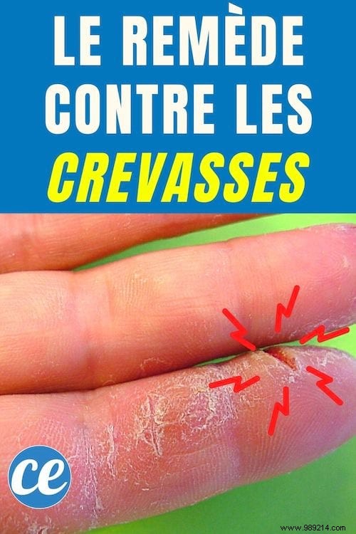 Heal Cracked Hands Naturally: Time-Tested Grandmother s Essential Oil Remedy