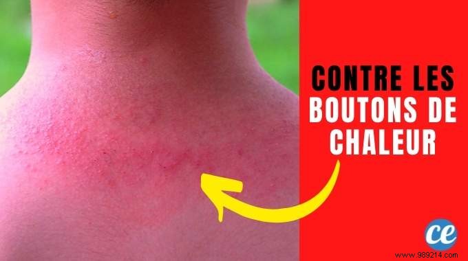8 Proven Home Remedies to Relieve and Prevent Heat Rash Effectively