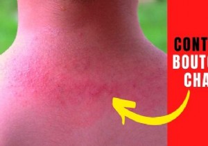 8 Proven Home Remedies to Relieve and Prevent Heat Rash Effectively