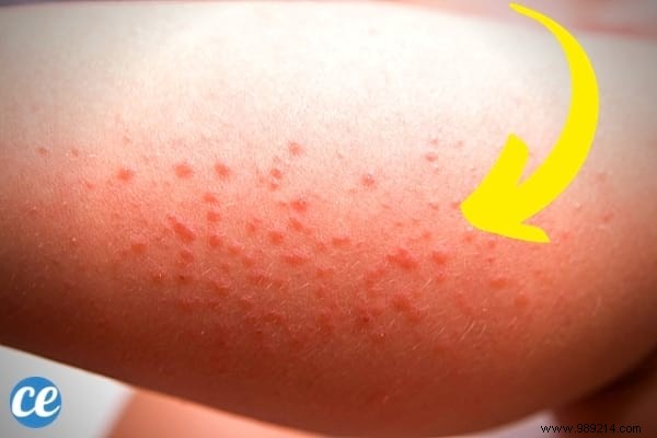 8 Proven Home Remedies to Relieve and Prevent Heat Rash Effectively