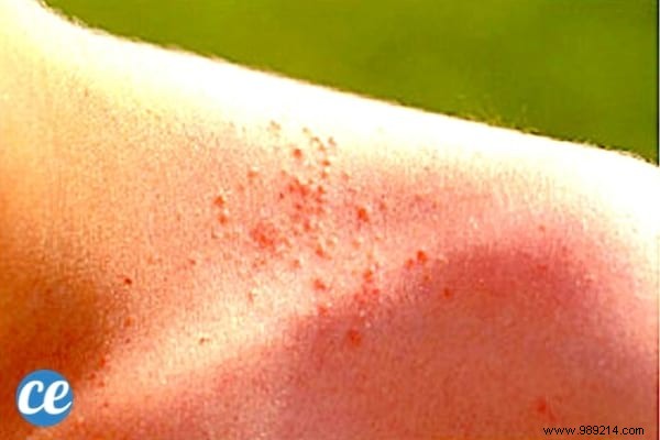 8 Proven Home Remedies to Relieve and Prevent Heat Rash Effectively