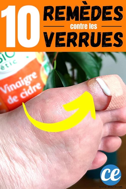 10 Time-Tested Natural Remedies to Remove Warts Quickly: Grandma s Secrets