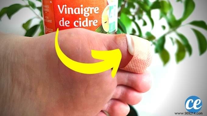 10 Time-Tested Natural Remedies to Remove Warts Quickly: Grandma s Secrets