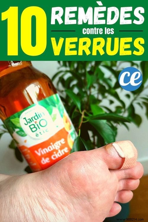 10 Time-Tested Natural Remedies to Remove Warts Quickly: Grandma s Secrets