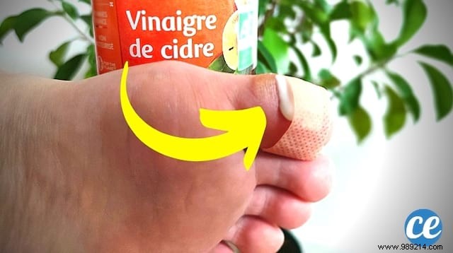 10 Time-Tested Natural Remedies to Remove Warts Quickly: Grandma s Secrets