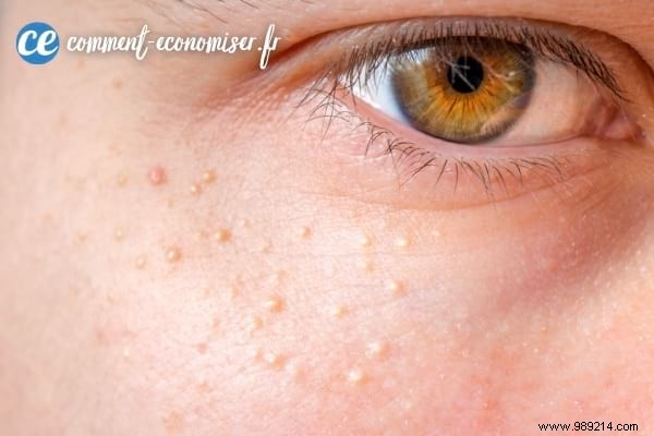 How to Safely Remove Milia Under Eyes: 16 Proven Natural Remedies