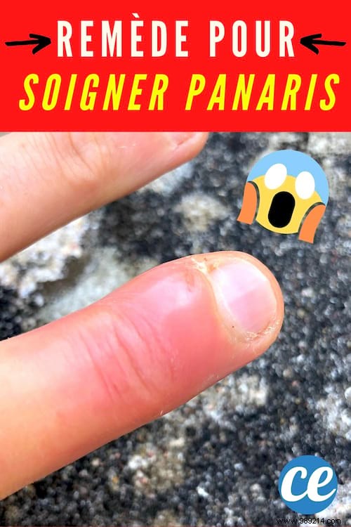 How to Treat Paronychia on Your Finger: A Proven 48-Hour Natural Remedy