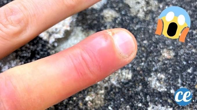 How to Treat Paronychia on Your Finger: A Proven 48-Hour Natural Remedy
