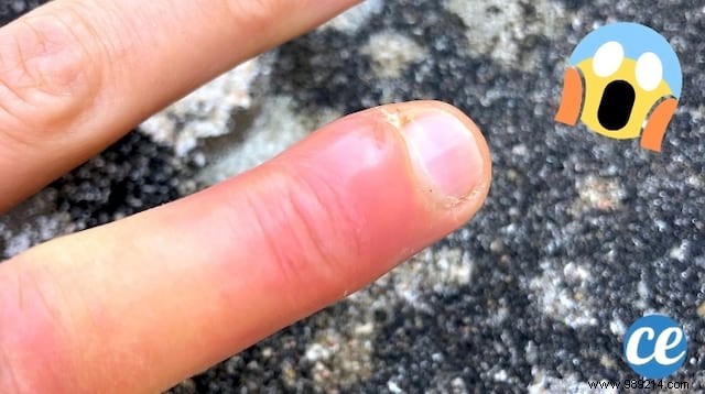 How to Treat Paronychia on Your Finger: A Proven 48-Hour Natural Remedy