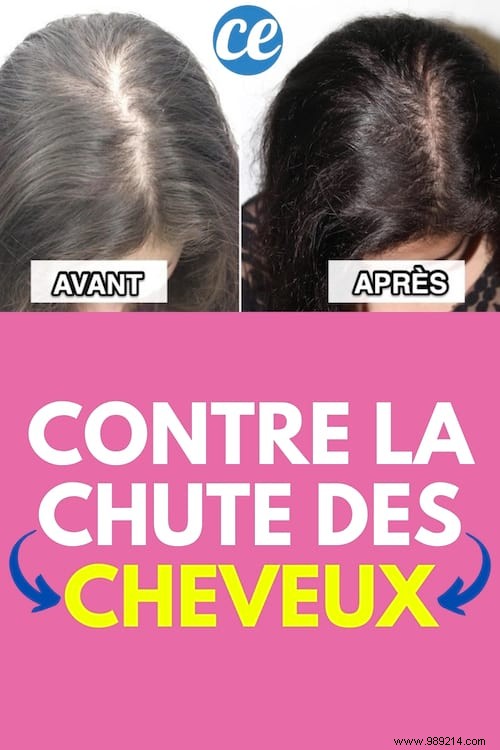 11 Proven Natural Remedies to Stop Hair Loss: Insights from My Experience