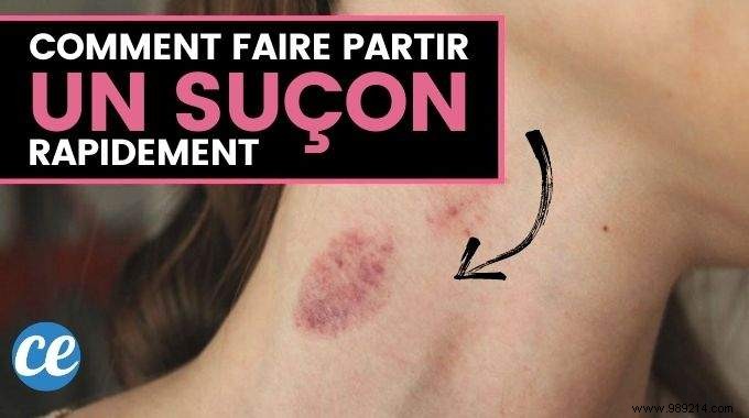 8 Dermatologist-Recommended Remedies to Fade a Hickey Faster