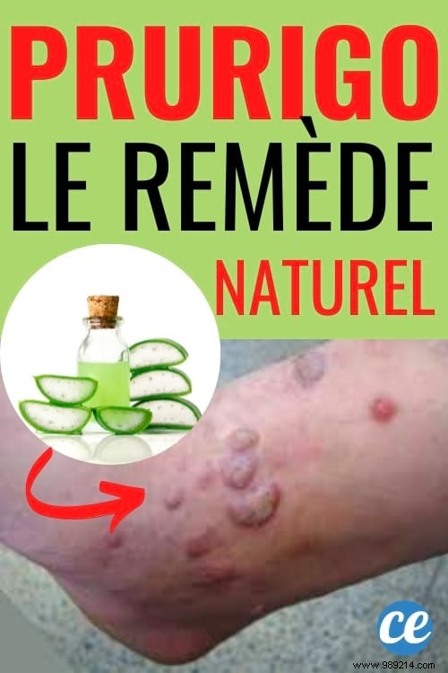 Effective Natural Remedy for Prurigo: Aloe Vera and Black Sesame Oil for Fast Itch Relief