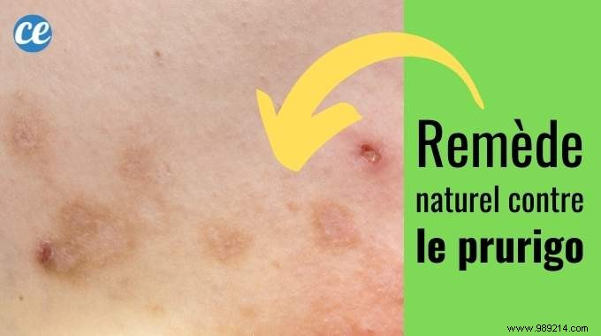 Effective Natural Remedy for Prurigo: Aloe Vera and Black Sesame Oil for Fast Itch Relief