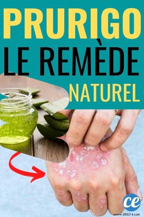 Effective Natural Remedy for Prurigo: Aloe Vera and Black Sesame Oil for Fast Itch Relief