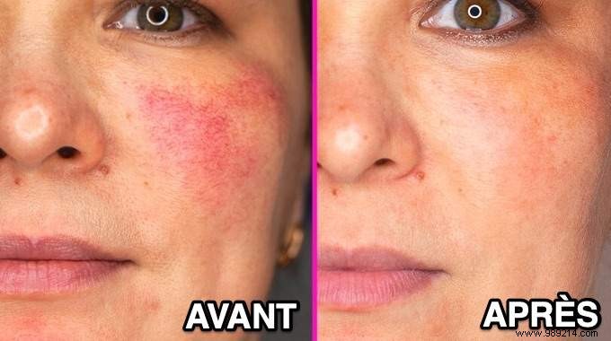 How I Cleared My Rosacea with a Simple Essential Oil Serum – Proven Natural Recipe