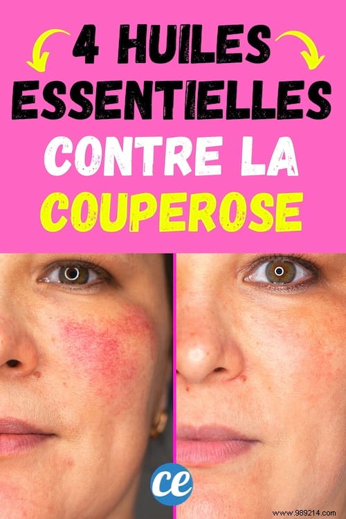 How I Cleared My Rosacea with a Simple Essential Oil Serum – Proven Natural Recipe