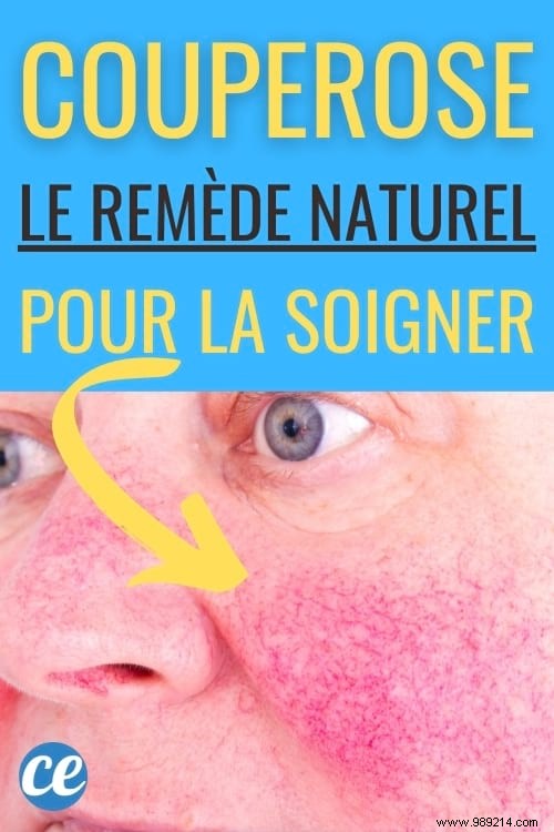 How I Cleared My Rosacea with a Simple Essential Oil Serum – Proven Natural Recipe