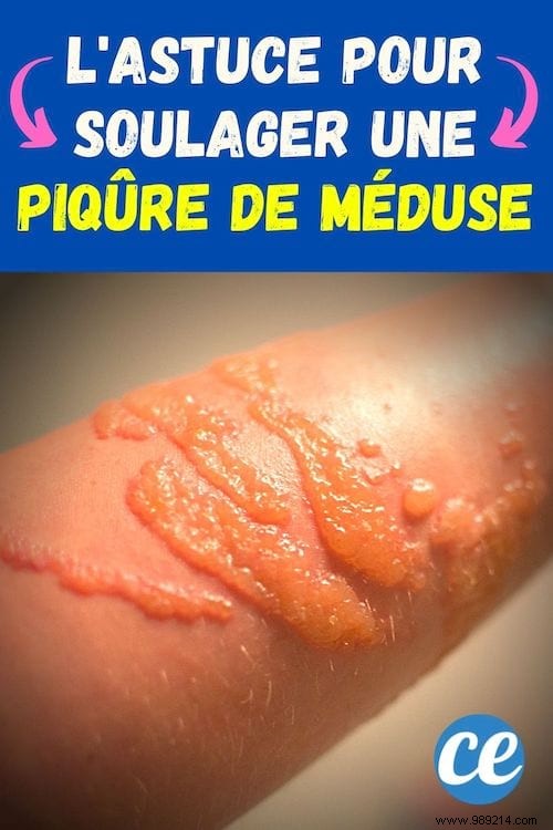 How to Quickly Relieve a Jellyfish Sting: My Surfer-Tested Baking Soda Remedy