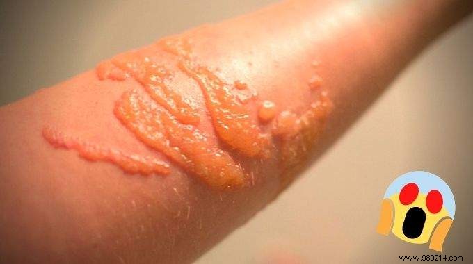 How to Quickly Relieve a Jellyfish Sting: My Surfer-Tested Baking Soda Remedy