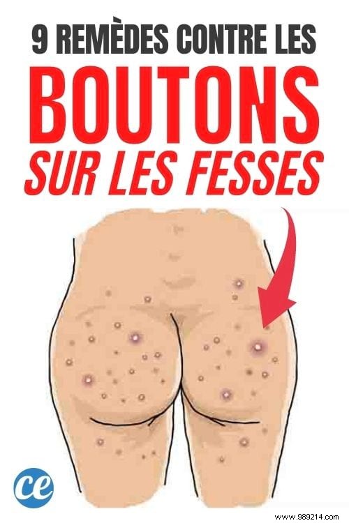 9 Proven Tips to Eliminate Buttocks Pimples for Good