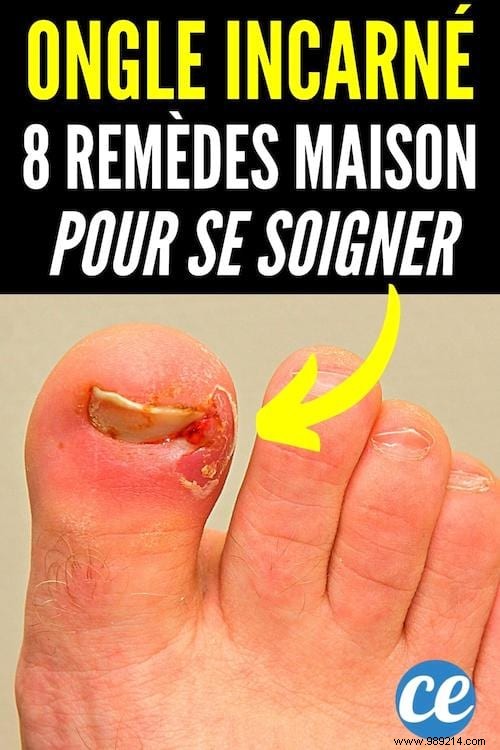 8 Proven Home Remedies for Ingrown Toenails: Expert Tips for Fast Relief