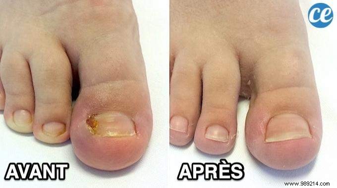8 Proven Home Remedies for Ingrown Toenails: Expert Tips for Fast Relief