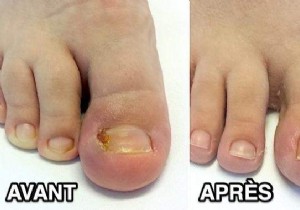 8 Proven Home Remedies for Ingrown Toenails: Expert Tips for Fast Relief