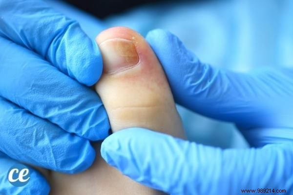 8 Proven Home Remedies for Ingrown Toenails: Expert Tips for Fast Relief