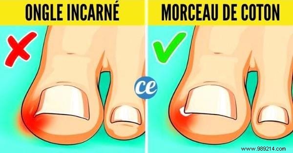8 Proven Home Remedies for Ingrown Toenails: Expert Tips for Fast Relief