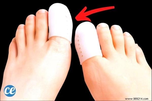 8 Proven Home Remedies for Ingrown Toenails: Expert Tips for Fast Relief