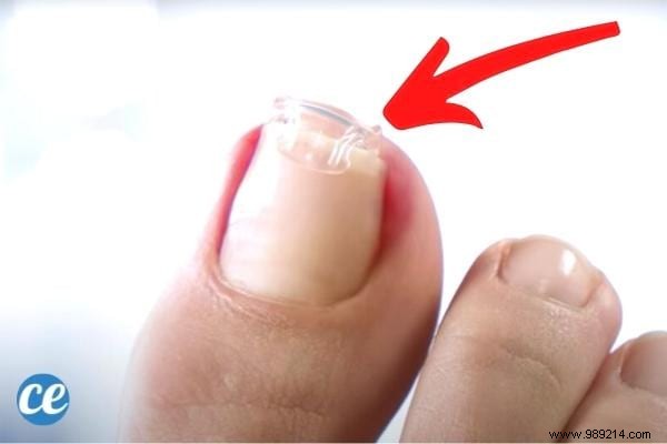 8 Proven Home Remedies for Ingrown Toenails: Expert Tips for Fast Relief