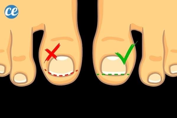 8 Proven Home Remedies for Ingrown Toenails: Expert Tips for Fast Relief