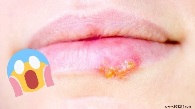 5 Proven Natural Remedies to Speed Up Cold Sore Healing