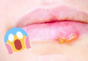 5 Proven Natural Remedies to Speed Up Cold Sore Healing