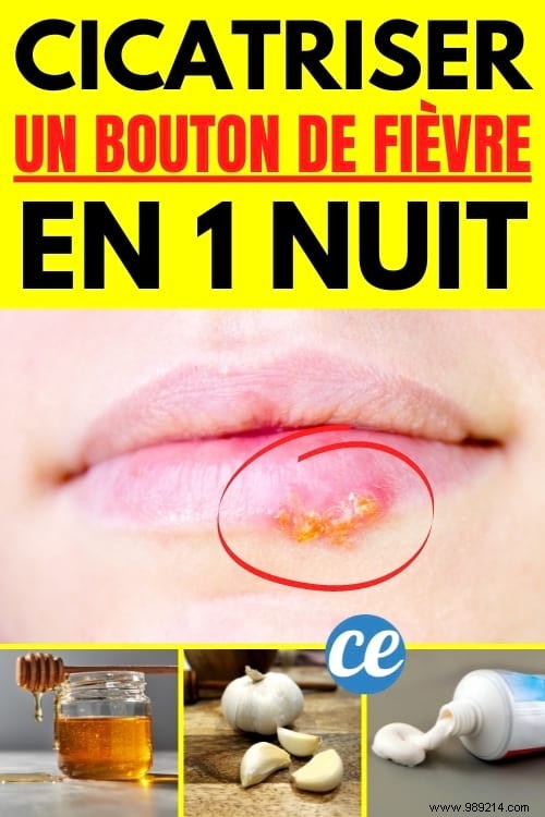 5 Proven Natural Remedies to Speed Up Cold Sore Healing