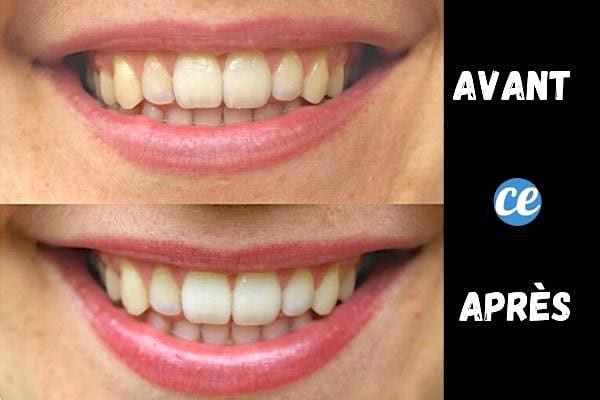 4 Science-Backed Benefits of Coconut Oil for Teeth: The Power of Oil Pulling