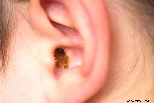 Why Avoid Cotton Swabs: Expert-Recommended Ways to Safely Clean Your Ears