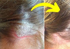 17 Dermatologist-Recommended Natural Remedies for Scalp Psoriasis Relief