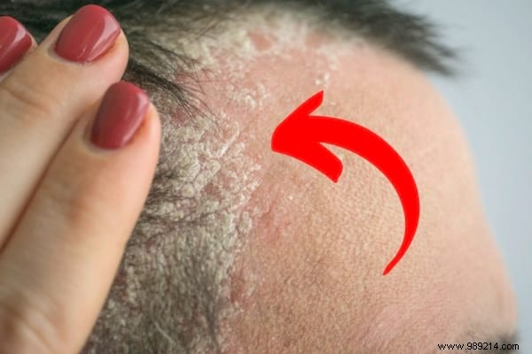17 Dermatologist-Recommended Natural Remedies for Scalp Psoriasis Relief