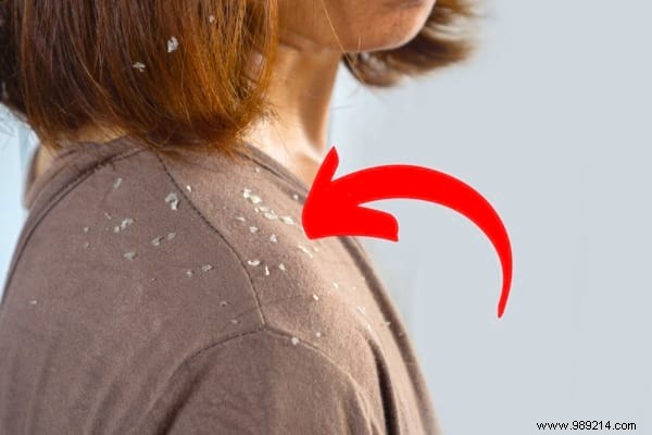 17 Dermatologist-Recommended Natural Remedies for Scalp Psoriasis Relief