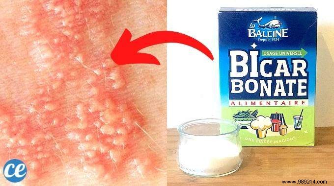 Relieve Scabies Itching Naturally with Baking Soda: Proven Home Remedy Tips