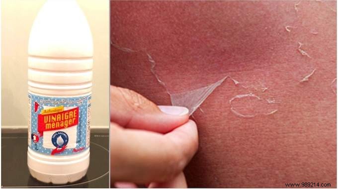 Prevent Sunburn Peeling and Blisters with White Vinegar: A Proven Natural Remedy