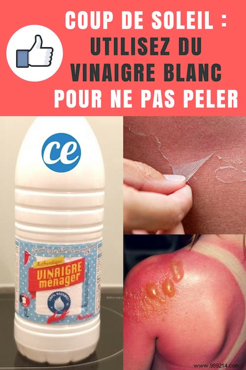 Prevent Sunburn Peeling and Blisters with White Vinegar: A Proven Natural Remedy