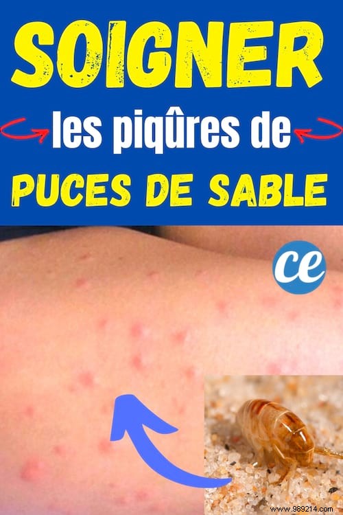 Instant Relief for Sand Flea Bites: Proven Baking Soda Remedy