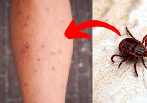 5 Time-Tested Grandmother s Remedies to Relieve Chigger Bite Itching